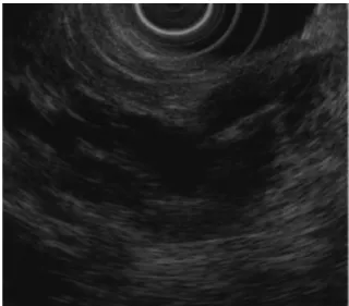 Fig. 6. Typical image of IPMN obtained by MR - ES.