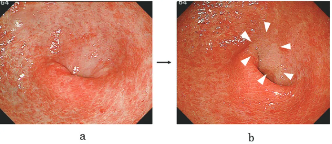 Fig. 4.  Detection of a new gastric tumor using L - menthol application : Case 1.