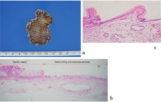 Fig. 6.  Detection of a new gastric tumor by L - menthol application : Case 2.