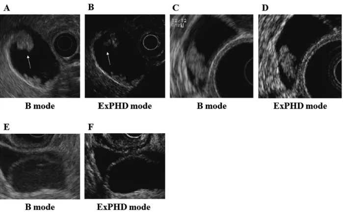Fig. 1.  Enhanced pattern of contrast - enhanced harmonic endoscopic ultrasonography (CH - EUS) for gallbladder  (GB) lesions.