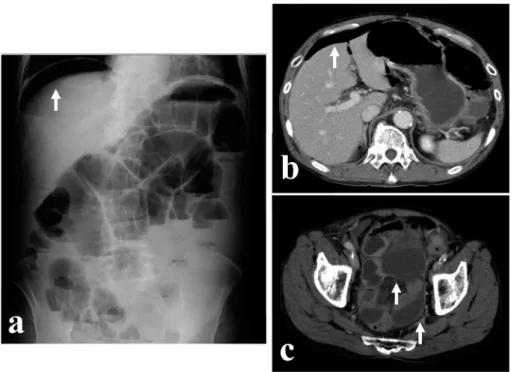 Fig. 5.  Computed tomography (CT) image taken sev- sev-en days after sev-endoscopic submucosal dissection.