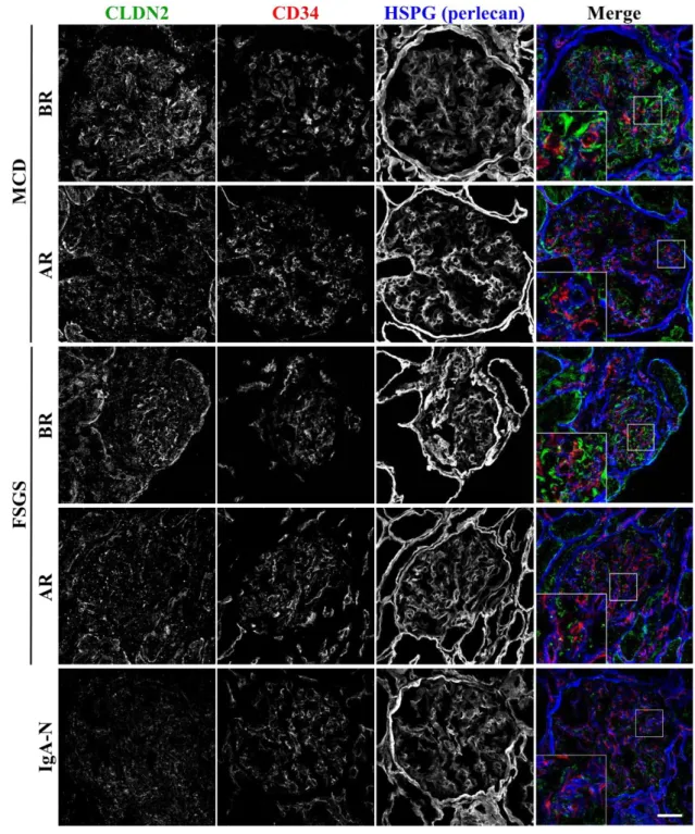 Figure 1: CLDN2 is ectopically expressed in MCD and FSGS glomeruli. 