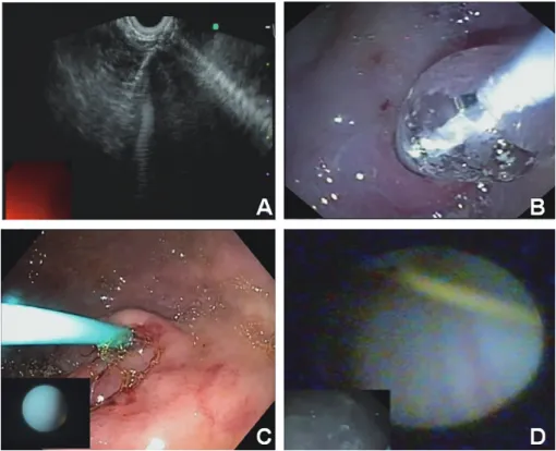 Fig. 2.  Endoscopic technique of peritoneal visualization.  (A)  A stomach defect was created with an endoscopic ul- ul-trasound - guide fine needle aspiration technique