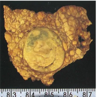 Figure 1 The macroscopic classification of the Liver Cancer Study  Group of Japan 