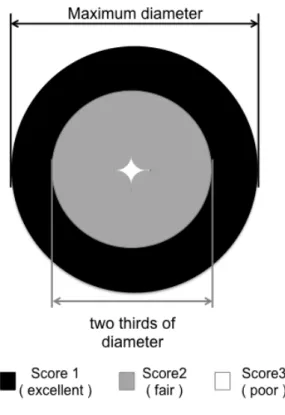 Figure  1.  Schema  for  the  inhibitory-effect  score.  Score  1,  luminal  opening 