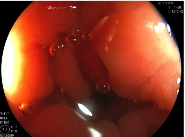 Figure 3-C. Inhibitory-effect score 3, severe spasm. 