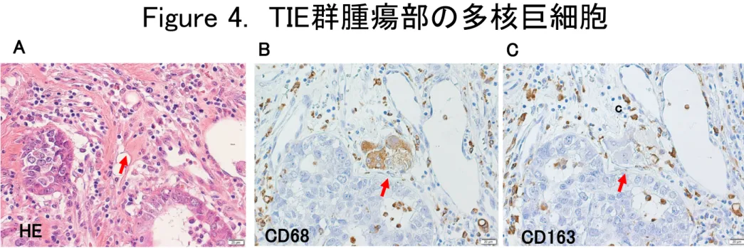 Figure 4. TIE群腫瘍部の多核巨細胞