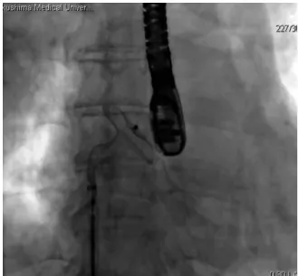 Fig. 1.  An angiographic image in transcatheter clo- clo-sure of atrial septal defect
