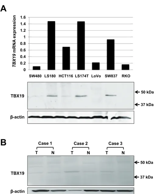 Fig. 2.  The expression of TBX19 in colon cancer cell lines and CRC specimens.  (A) TBX19 expression analyses of  mRNA by real - time PCR and protein by western blot in 7 colon cancer cells