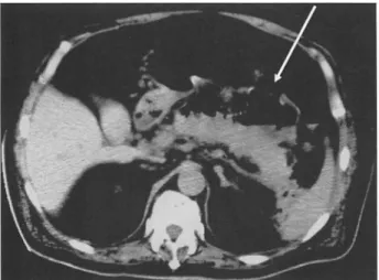 Fig. 4.  An  abdominal  CT  scan  perform ed  2 weeks  after  hematochez ia  showed  com· 