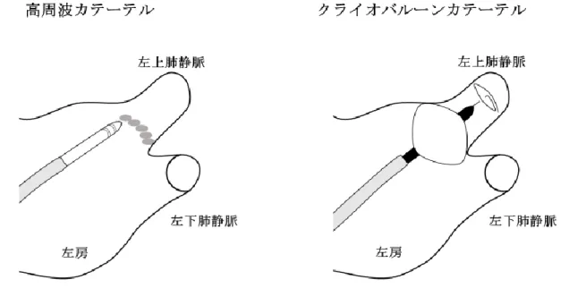 図 3 高周波カテーテルとクライオバルーンカテーテルによる肺静脈隔離