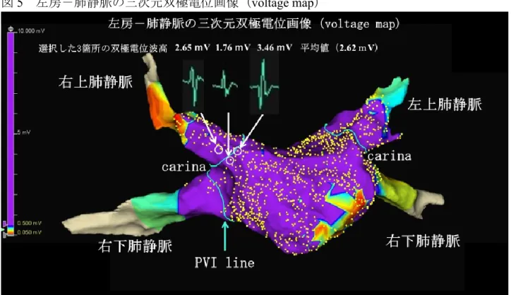 図 5  左房－肺静脈の三次元双極電位画像（voltage map） 