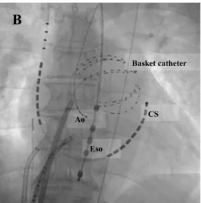 図 4. 実際の Basket catheter と左心房留置時の透視画像