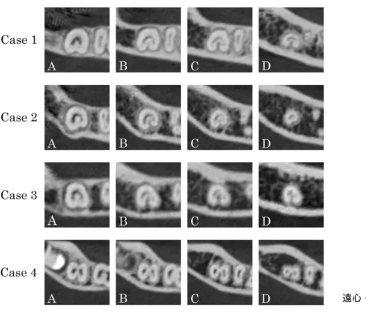 Fig. 4 MDCT 画像で観察された 4 つの断面での樋状根管の様々なパターン Case 1 : A1B1C1D1 ( 断面 A ‐ D まで 1 根管 ) 