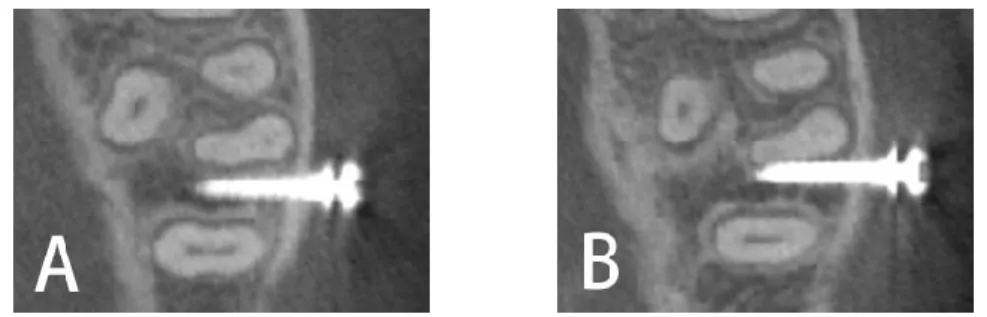 Fig 1. The self-drilling anchor screw used in this study: screw thread length, 8.0 mm; 
