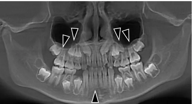 Figure 5 ：9 歳女児の CBCT 再構成パノラミック画像 