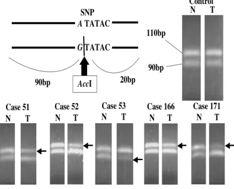 Figure 4. RFLP analysis of LOH in the VHL gene in samples of tongue  squamous cell carcinoma