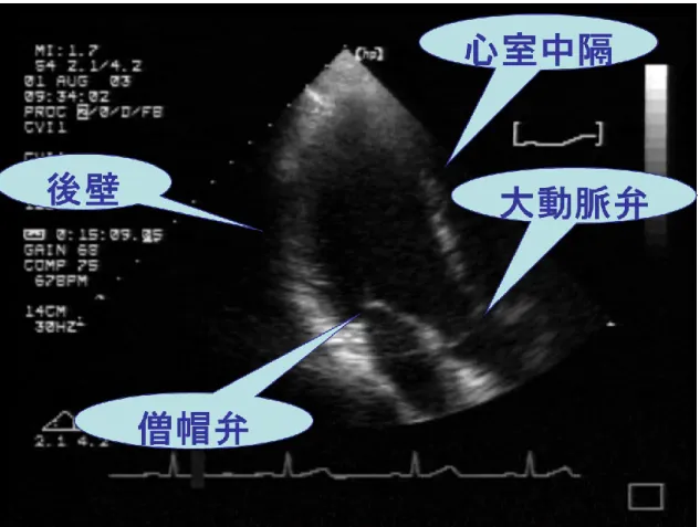図  ７  心尖部長軸断面 