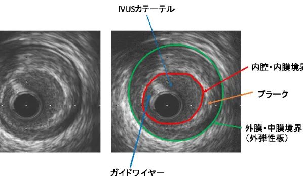 図 3：IVUS による血管の評価 