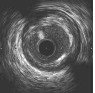 図 4：iMAP-IVUS によるプラークの組織評価 