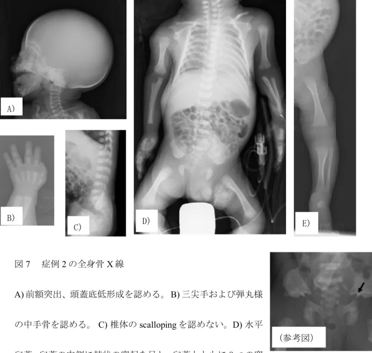 図 7  症例 2 の全身骨 X 線 A)  前額突出、頭蓋底低形成を認める。  B)  三尖手および弾丸様 の中手骨を認める。  C)  椎体の scalloping を認めない。 D)  水平 臼蓋、臼蓋の内側に棘状の突起を呈し、臼蓋とともに 3 つの突 起と数えられる ( trident pelvis ：参考図➡ ) を認める。 E)  大腿骨遠位骨幹端に cupping や flaring を認めない。    Cupping ： 骨幹端の中央部が骨幹側に凹の形態を呈する杯状の変形を指す Flarin