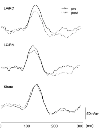 Figure 6. Source strength waveform of IES-evoked OP activity under three tDCS conditions