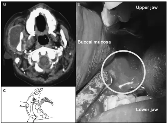 Fig. 2 Head enhanced computed tomography (CT) on day 10 showing abnormal sig- Fig. 2 Head enhanced computed tomography (CT) on day 10 showing abnormal sig-nals  associated  with  a  right  phlegmon  of  the  cheek  (a).  Abscess  drainage  was   per-formed