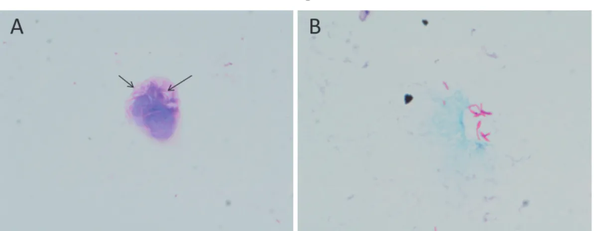 Fig. 2 Microscopic examination of the dermatologic lesion.  A, Gram stain; arrows indicate so-called ghost bacteria. B, Ziehl-Neelsen stain.  BA Fig. 3 Mycobacterium haemophilum colonies on agar plates after 14 days.  A, chocolate agar in 5% CO 2  at 35℃. 