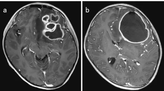Fig. 1 Enhanced MRI showing (a) multiple abscesses in the left frontal lobe of the brain  upon admission and (b) a ring-enhancing developed lesion that caused a midline shift of  the left frontal lobe to the right side of the brain 24 days after admission.