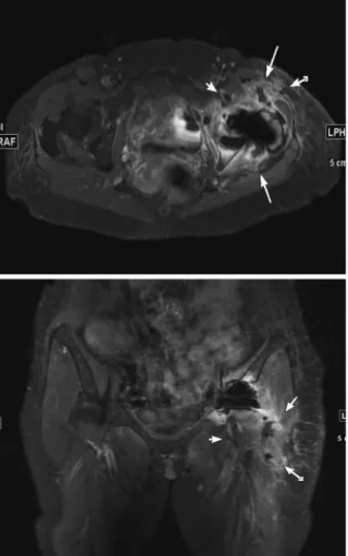 Fig. 1 Appearance of the surgical site  No redness and swelling is seen around the surgi- cal sites. But, when the surgical sites were palpat-ed digitally, there was an incompatibility