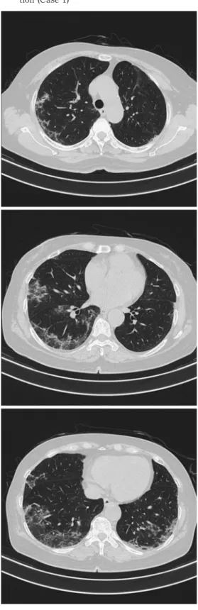 Fig. 5 Chest X-ray on admission (Case 2)
