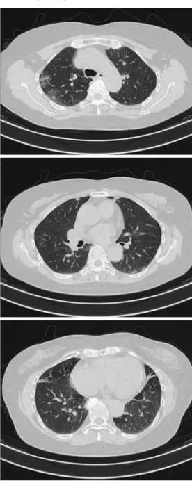 Fig. 7 Chest CT on admission (Case 2) Fig. 8 Chest  CT  on  day  6  of  hospitaliza- hospitaliza-tion (Case 2) 身体所見：右足関節の可動時痛，軽度腫脹あり 血液検査：Table 3に示す． 画像検査：Fig