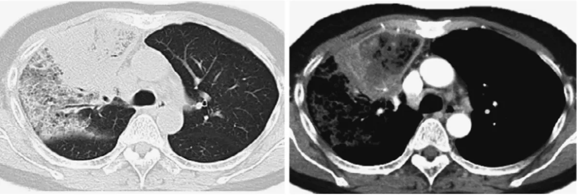 Fig. 3 Contrast-enhanced CT image The image shows an abscess in the upper lobe of the right lung