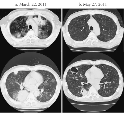 Fig. 1 Chest  CT  scan  after  surviving  the  tsunami  showed  diffuse  granular  shadows,  nodules  and  consolidations  (a),  most  of  which  disappeared  or  formed  cavities after treatment (b)