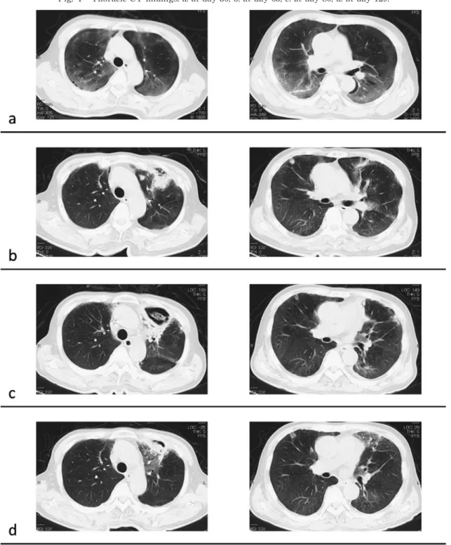 Fig. 1 Thoracic CT findings. a: at day 30, b: at day 65, c: at day 80, d: at day 129. ルビテグラビル/コビシスタット/テノホビルアラフェ ナミドフマル酸塩/エムトリシタビン（GEN）で ART を開始した．その後 day 57 から発熱，咳嗽，胸痛，炎 症反応の増悪（Table 2）を認めた．スルバクタム/ア ンピシリンを開始したが呼吸器症状は改善せず，CRP は 17.23mg/d4L ま で 上 昇 し，胸 部 CT（