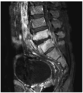 Fig. 5 Thoracoabdominal  CT  on  hospital  day  5  (Case2)