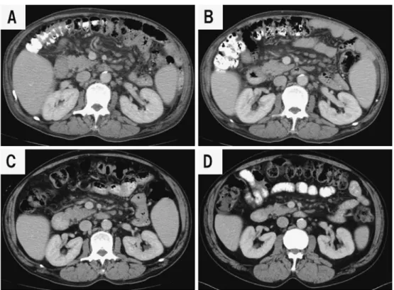 Fig. 3 Abdominal CT images (A, before ART; B, 2 weeks after ART; C, 3 months after  ART;  D,  1  year  after  ART).  Abdominal  lymphadenopathy  improved  drastically  during  the clinical course