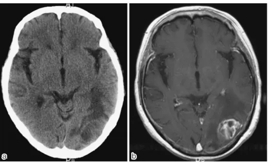 Fig. 1 (a) Computed tomography (CT) and (b) contrast-enhanced magnetic resonance im- Fig. 1 (a) Computed tomography (CT) and (b) contrast-enhanced magnetic resonance im-aging (MRI) brain scans show a left tempoparietal lobe nodule with edematous lesions aa