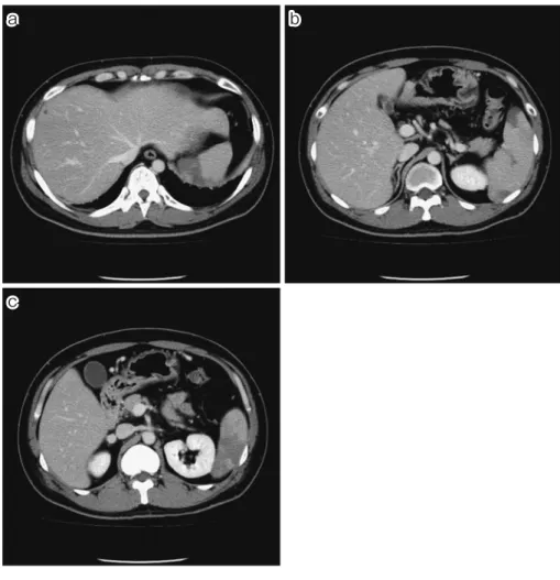 Fig. 2 a, b, c: Contrast enhanced computed tomography performed on the 4th day  after admission