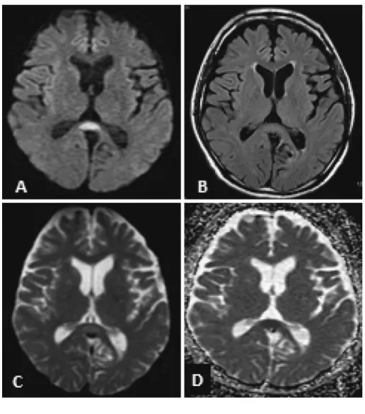 Fig. 2 MRI imaging on day 5, showing high signal lesions in the splenium of the  corpus  callosum  (SCC)  on  DWI  (A)  and  relatively  high  intensity  on  FLAIR  (B)  and T2-weighted (C). ADC map (D) shows reduced diffusion (450×10 3  mm 2 /sec) 考 察 今回我