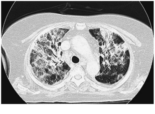 Fig. 1 Chest  computed  tomography  scan  find- find-ings on postoperative day 8Table 1 Laboratory findings on postoterative day 8 GLU 187 mg/dL WBC 8,900 /μL T-BIL 1 mg/dL Neu 94 % γGTP 586 IU/L Lym 4 % AST 118 IU/L Hb 8.8 g/dL ALT 184 IU/L MCV 96 fL LDH 