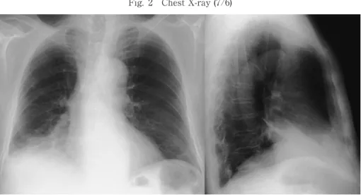 Fig. 2 Chest X-ray (7/6) Fig. 3 ＊Abbreviations  AMK: amikacin, BS: bronchoscopy, CAM: clarithromycin, FLCZ: fluconazole, L-AMB: lipo- somal amphotericin B, MEPM: meropenem, PSL: prednisolone, ST: sulfamethoxazole-trime-thoprim combination 考慮し，各種培養検査提出後，メロペ