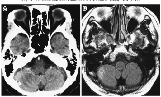 Fig. 4 A: Head contrast-enhanced CT (7/13), B: Head MRI (7/19) A B Fig. 5 A: Chest CT (8/3), B: Head contrast-enhanced CT (8/6) A B 剤は増量の方針とした．eGFR 40mL ! 分の腎機能障害 のため，ST 合剤を 3 錠分 3（トリメトプリム換算 240 mg）に増量，AMK は，ピーク値 15〜30μg! mL，ト ラフ値 5〜10μg! mL を目標に，300mg×2 回