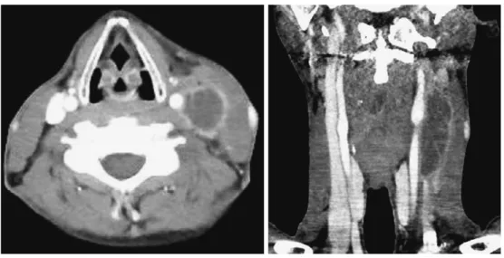 Fig. 2 Contrast-enhanced CT scan of the neck on admission Left internal jugular vein thrombus with ringed enhanced venous wall is shown
