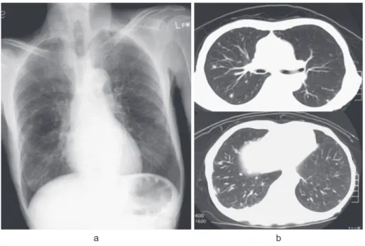 Fig. 1 Chest X-ray and CT findings on admission a. Chest X-ray shows multiple small nodular shadows in both lung fields.