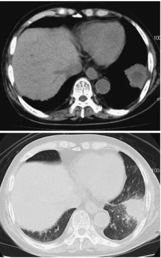 Fig. 1 Chest CT on admission shows mass shad- Fig. 1 Chest CT on admission shows mass shad-ow with central low attenuation area in the left  lower lobe Fig. 2 Clinical course （VRCZ）の併用療法に変更した．経過中抗菌薬も併 用したが，穿刺液，気管支洗浄液，胸水いずれも嫌気培養を含めて細菌は検出されず，真菌の単独感染と考えられた．入院