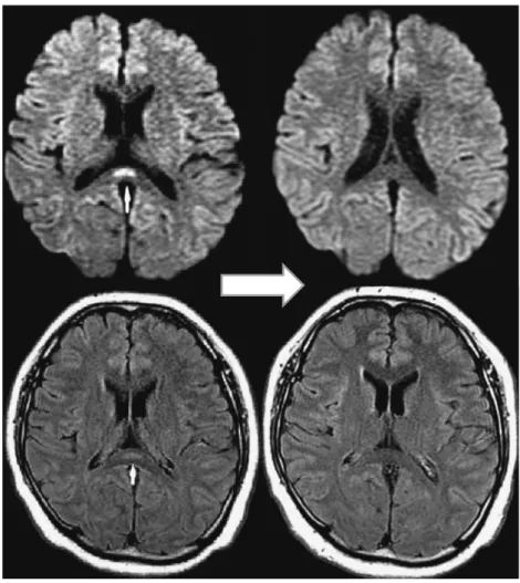 Fig. 3 Brain  magnetic  resonance  imaging  (MRI)  performed  on  the  eighth  day of illness revealed a high intensity signal on the central splenium of  the corpus callosum using diffusion-weighted imaging (DWI) and FLAIR