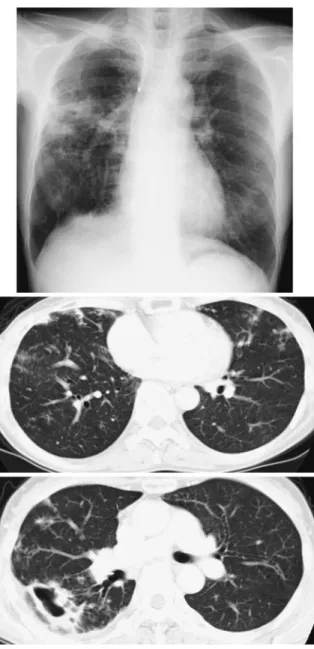 Fig. 1 Chest  X-ray,  and  chest  computed  tomog- tomog-raphy scan findings on the first visit in case 3.