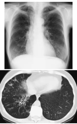 Fig. 3 Chest  X-ray,  and  chest  computed  tomog- tomog-raphy  scan  findings  after  a  right   pneumonecto-my in case 3.