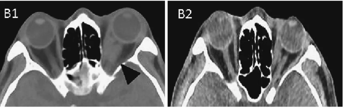 Fig. 1B Axial CT of the orbits (B1). A mass lesion is present in the left orbit on admission (arrow  head).  The  intraocular  pressure  of  the  right  and  left  were  different  (right;  12mmHg,  left; 